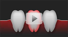Tooth-Replacement-Townsville-video